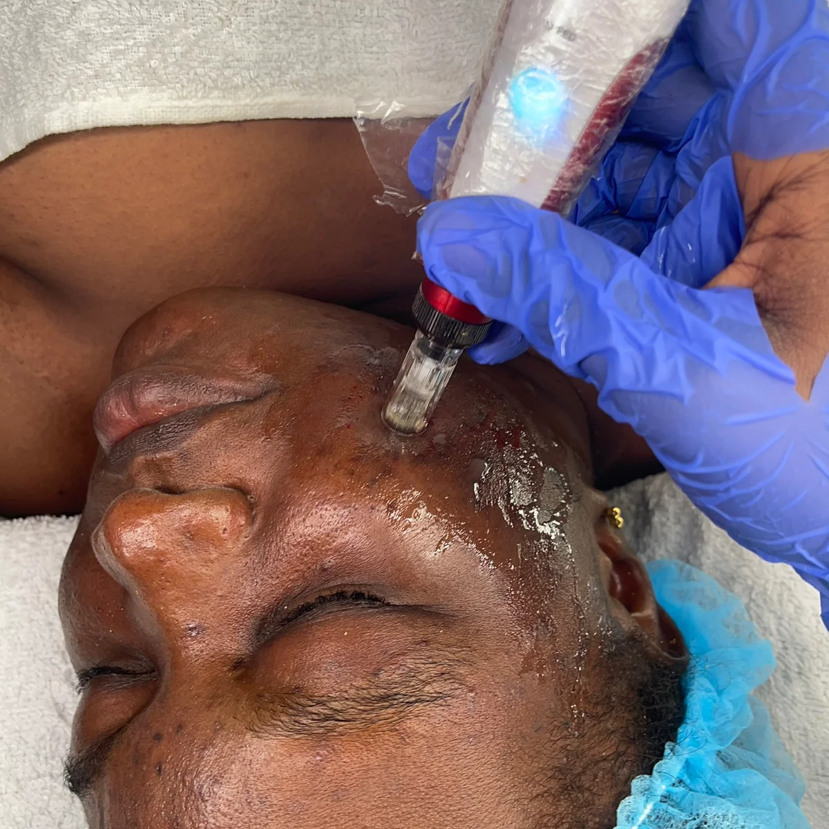 Microneddling facial